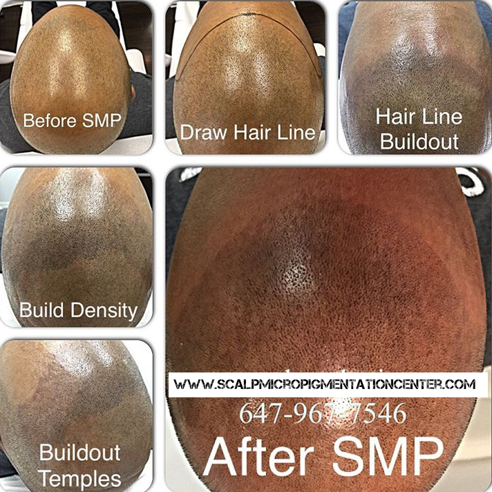 Scalp Micropigmentation Training Center Head Office | 19 Aerodrome Crescent #301, East York, ON M4G 4J3, Canada | Phone: (844) 877-2257