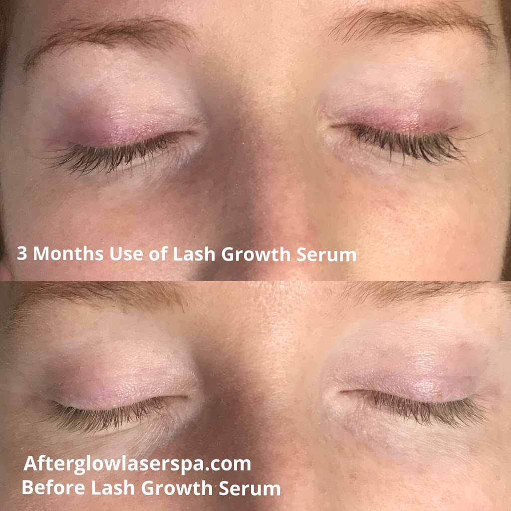 Afterglow Laser Spa | 310 Wellington Rd Unit J, London, ON N6C 4P4, Canada | Phone: (519) 601-0081