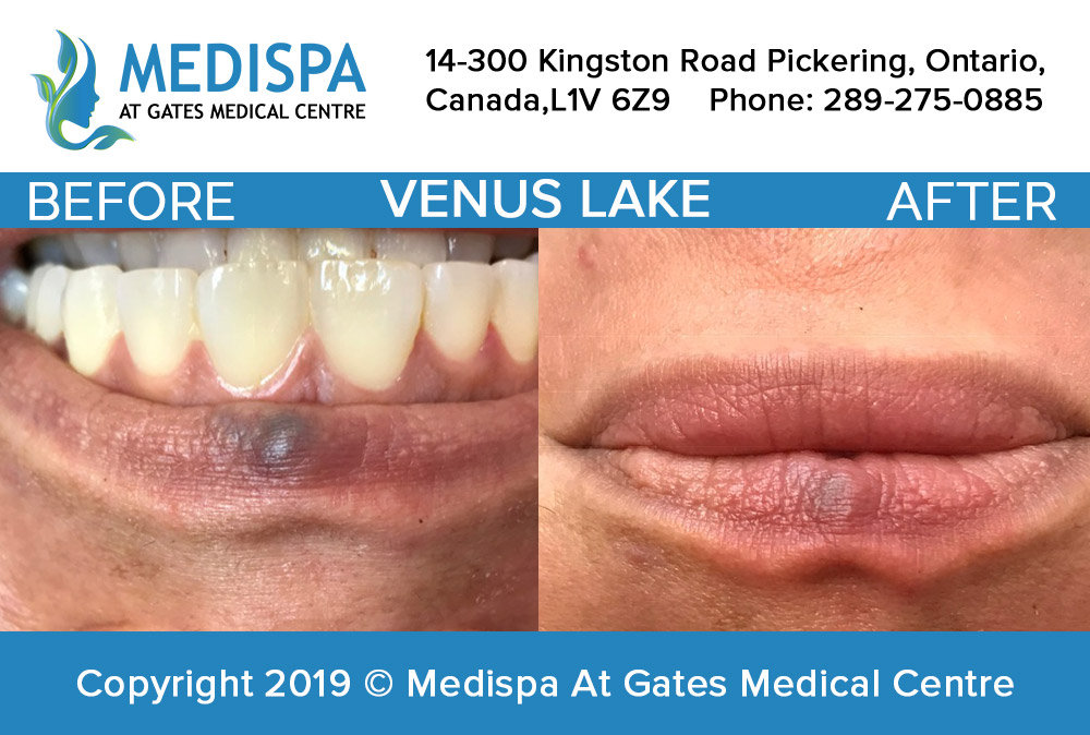 MediSpa At Gates Medical Centre | 14-300 Kingston Rd, Pickering, ON L1V 6Z9, Canada | Phone: (289) 275-0885