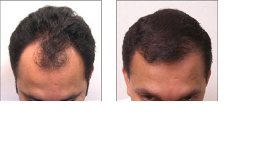 Buffalo Hair Transplant Center | 5007 Transit Rd Suite #2, Depew, NY 14043, USA | Phone: (716) 226-1020