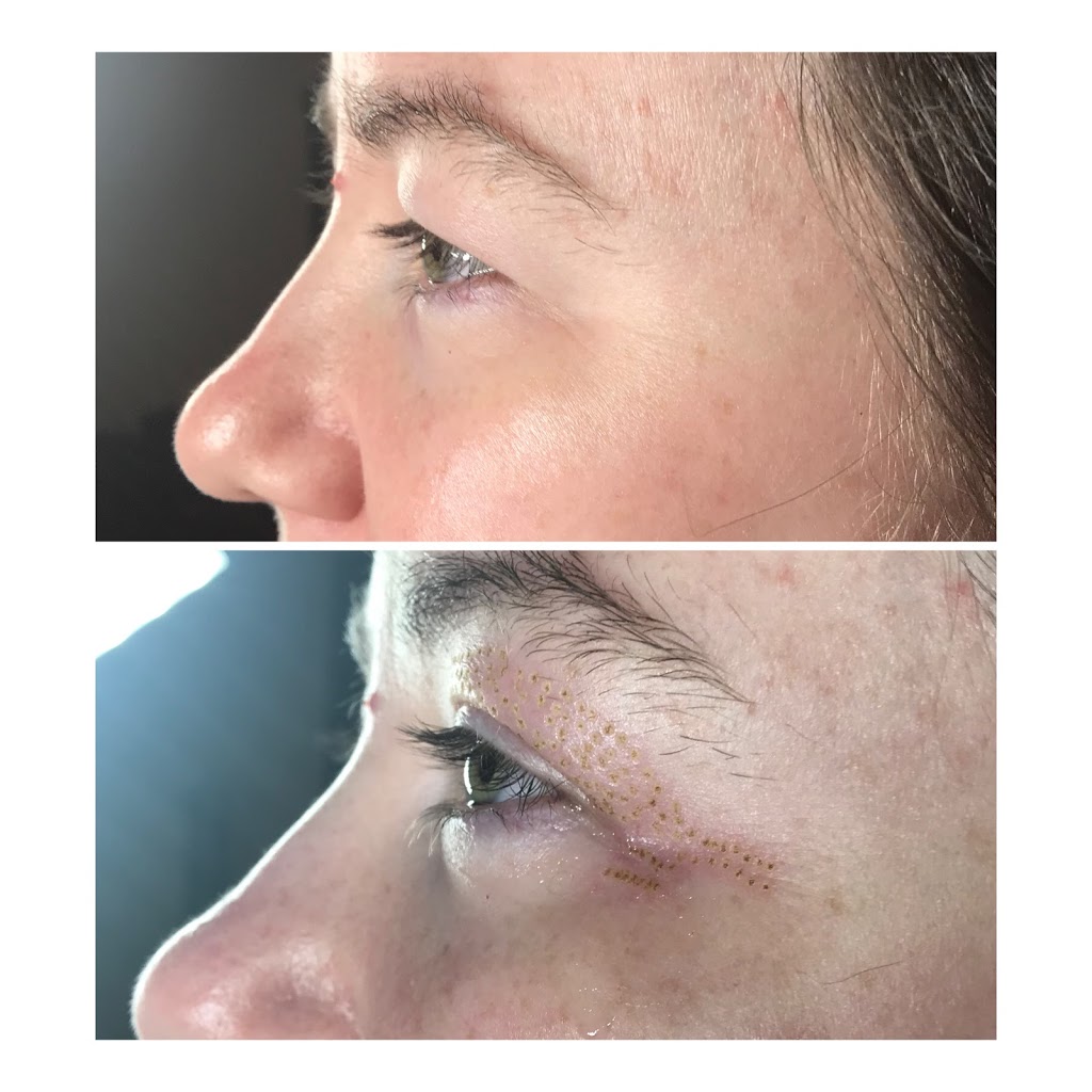 Plasma Skin Regeneration | 00 Ranch Gate, Strathmore, AB T1P 0B4, Canada | Phone: (403) 901-4663