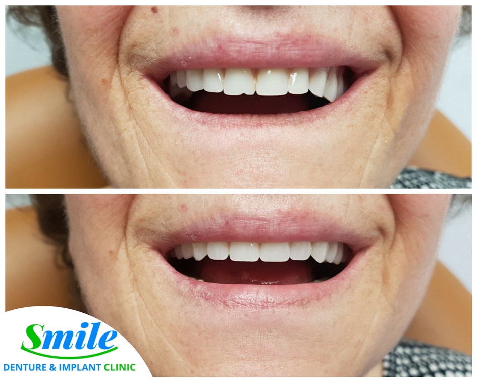 Smile Denture & Implant Clinic | 1825 Woodward Dr, Ottawa, ON K2C 0P9, Canada | Phone: (613) 702-2656