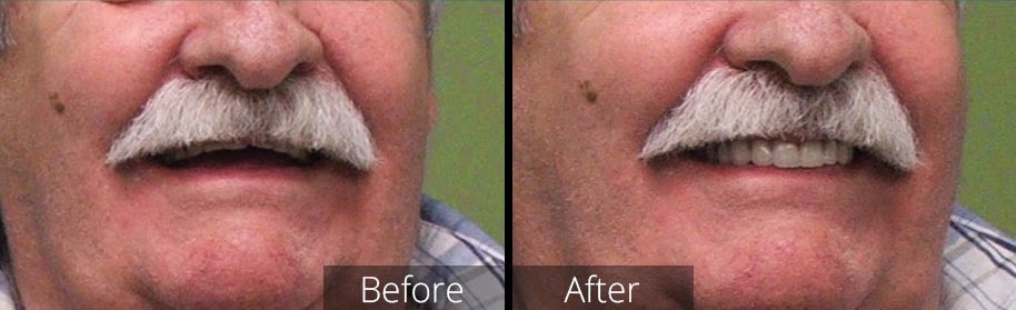 Saanich Walk-in Denture Clinic - Denturist in Victoria | 3581 Shelbourne St #101A, Victoria, BC V8P 4G8, Canada | Phone: (250) 595-1665