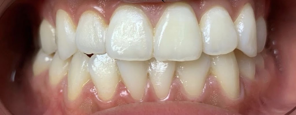 Stan Whitening | 1872 Harbour St, Port Coquitlam, BC V3C 1A3, Canada | Phone: (778) 239-0230