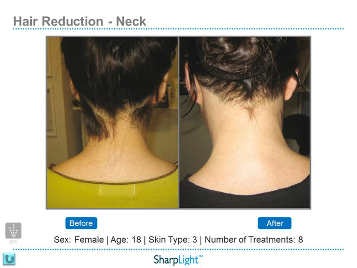 Refresh Laser & Skin Rejuvenation | 901 Heritage Dr SW, Calgary, AB T2V 2W8, Canada | Phone: (403) 464-9417