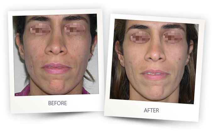 Dermace Advanced Skin Care Clinic | 6633 Hwy 7 suite 303, Markham, ON L3P 7P2, Canada | Phone: (905) 554-8144