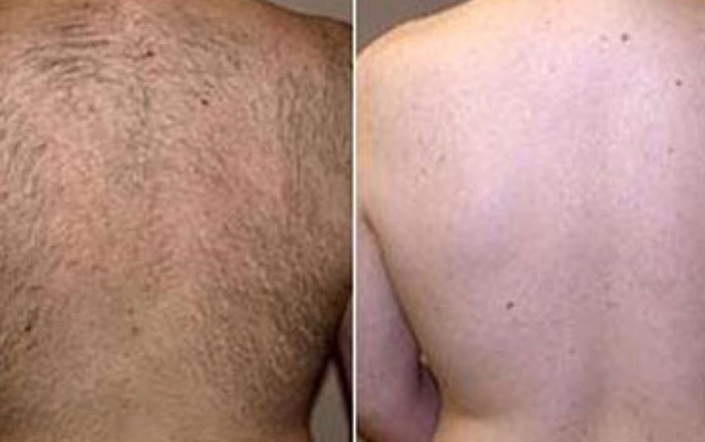 Lendrum Sugaring and Laser | 5220 114b St NW, Edmonton, AB T6H 3N5, Canada | Phone: (780) 270-3122