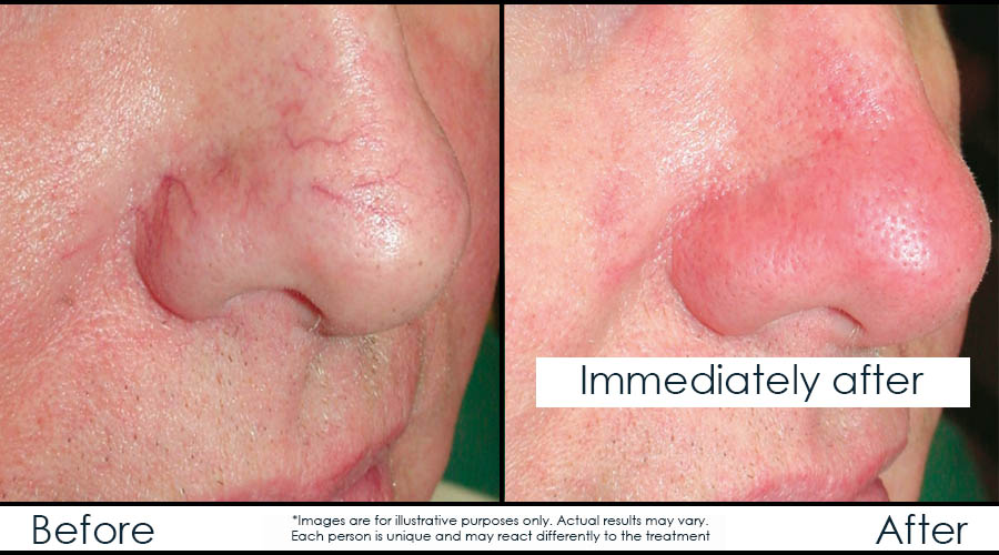 Infinium Médecine Esthétique | 729 Boulevard Saint-Joseph, Gatineau, QC J8Y 4B6, Canada | Phone: (819) 771-4284