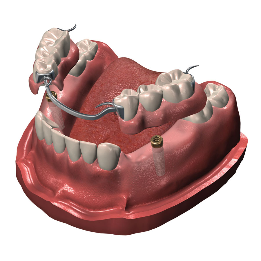 Denturologie Mon Sourire I Denturologiste Saint Laurent | 2505 Rue des Nations, Saint-Laurent, QC H4R 3C8, Canada | Phone: (514) 506-4983