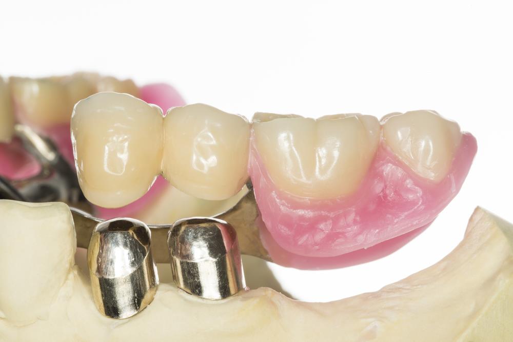 Clinique De Denturologie Gabrielle Lambert | 1460 Boulevard Rome, Brossard, QC J4W 2T4, Canada | Phone: (450) 486-6624