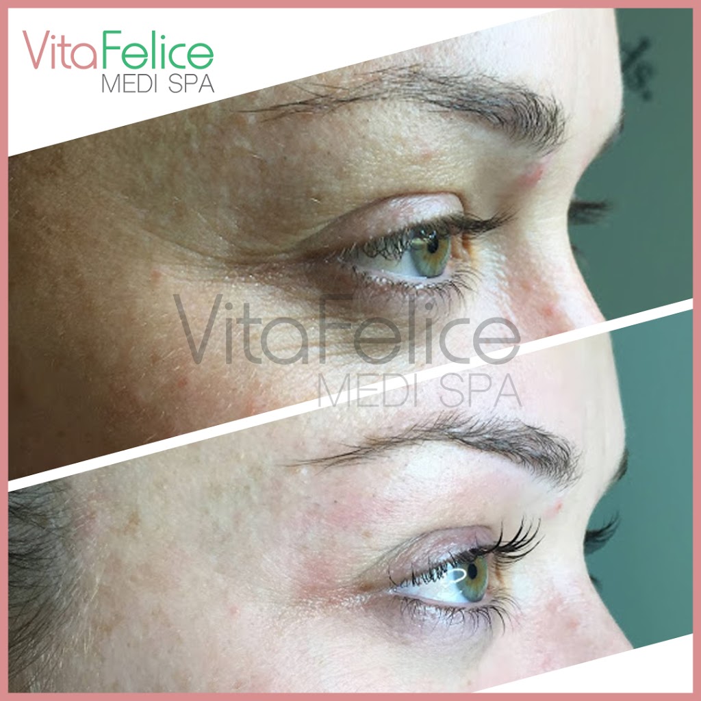 Vita Felice Medi Spa | 661 Columbia St, Unit 103, New Westminster, BC V3M 1A8, Canada | Phone: (778) 987-5480