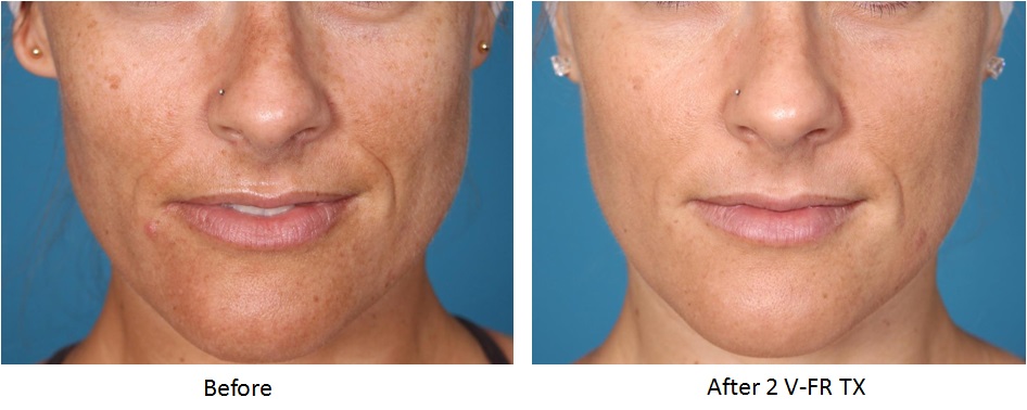 Beauté MédiSpa St Lazare | 956 Rue des Monarques, Saint-Lazare, QC J7T 0K7, Canada | Phone: (514) 465-4645