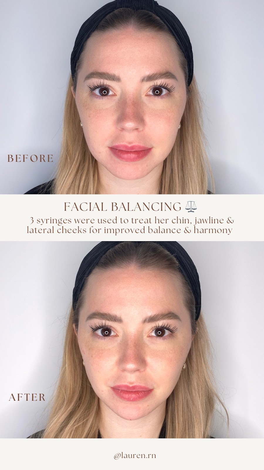 Lauren Landry RN - Halifax Injector: Botox and Dermal Fillers | 6461 Quinpool Rd, Halifax, NS B3L 1B1, Canada | Phone: (902) 789-1174