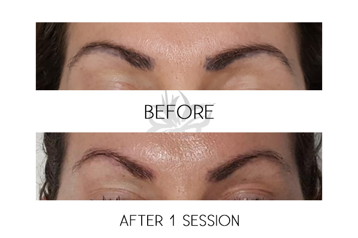 Azalea Laser Clinic | 7567 Blvd. Newman, LaSalle, QC H8N 1X3, Canada | Phone: (844) 429-2532