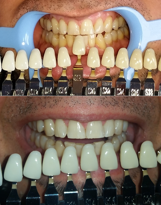 Teeth Whitening | 277 Lawson St, Pickering, ON L1V 5V3, Canada | Phone: (647) 854-7513
