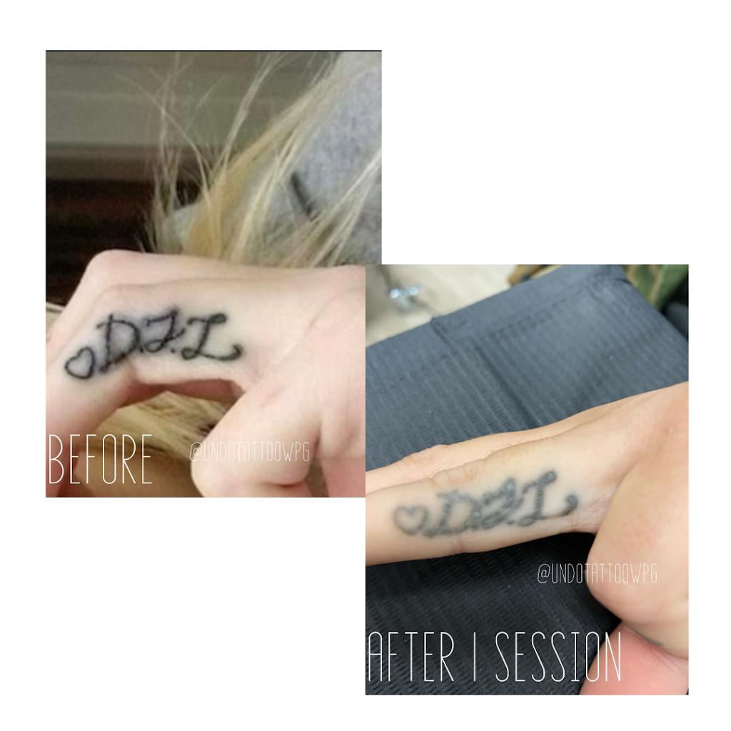 Undo Tattoo Laser Tattoo Removal | 169 Marion St, Winnipeg, MB R2H 0T3, Canada | Phone: (204) 558-8636