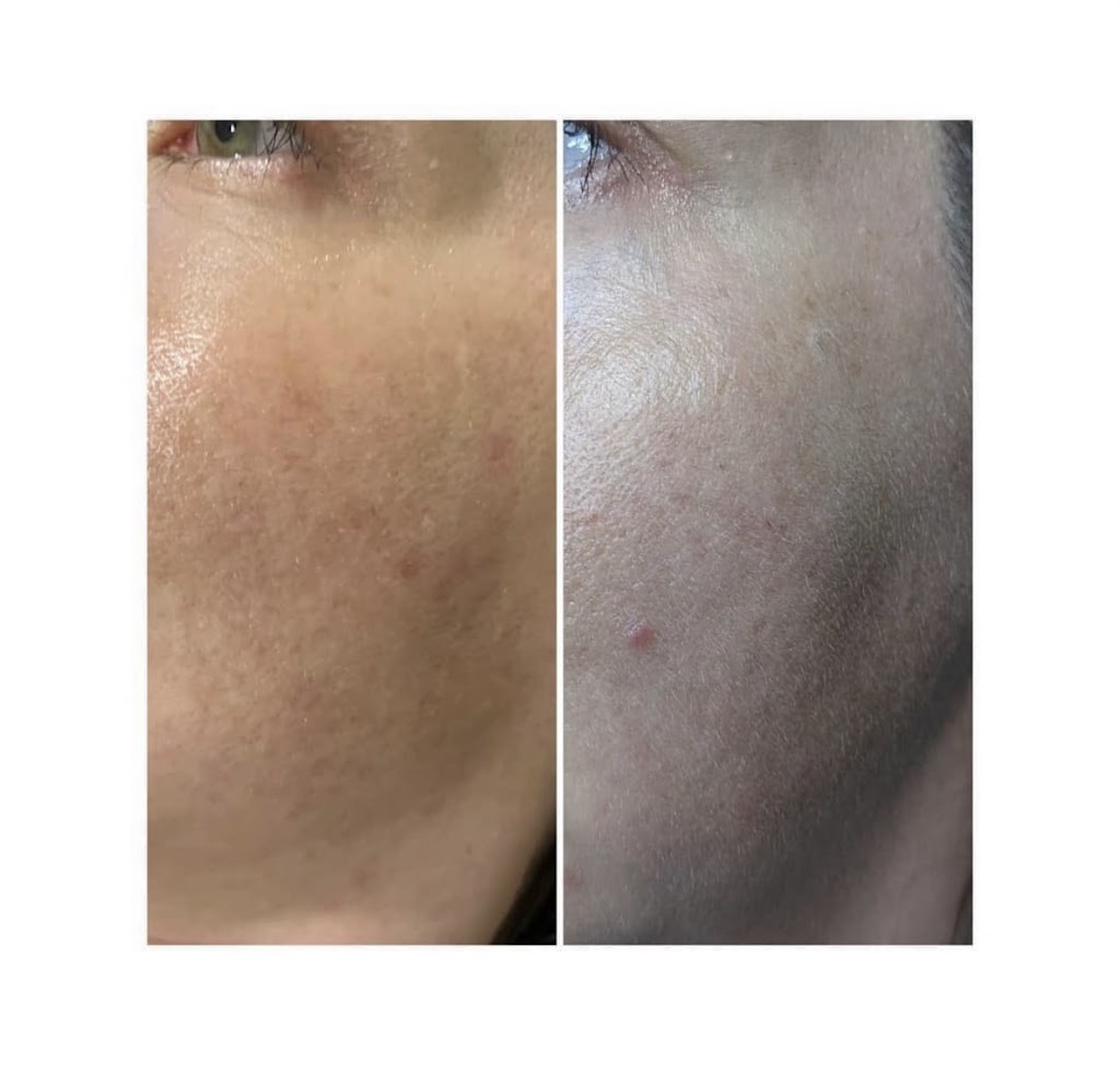 Alis Skin + Laser | 491 Wt Hill Blvd S #60, Lethbridge, AB T1J 1Y6, Canada | Phone: (403) 381-8295