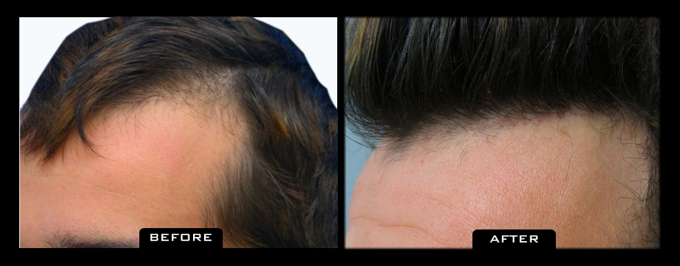 NuHair Medical | 6345 120 St #123, Delta, BC V4E 2A6, Canada | Phone: (604) 999-5747