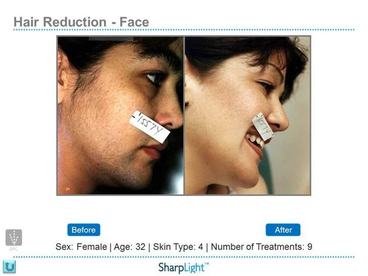 Refresh Laser & Skin Rejuvenation | 901 Heritage Dr SW, Calgary, AB T2V 2W8, Canada | Phone: (403) 464-9417