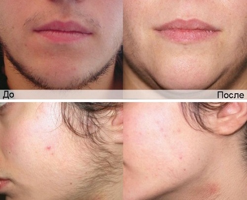 Skin Care Lazer YXE | Sunsera Salon. Ask for Olga (Laser technician, 815 Gray Ave, Saskatoon, SK S7N 2K6, Canada | Phone: (639) 318-9969