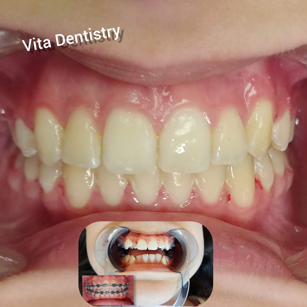 Vita Dentistry | 879 York Mills Rd Unit 6, North York, ON M3B 1Y5, Canada | Phone: (647) 276-0076