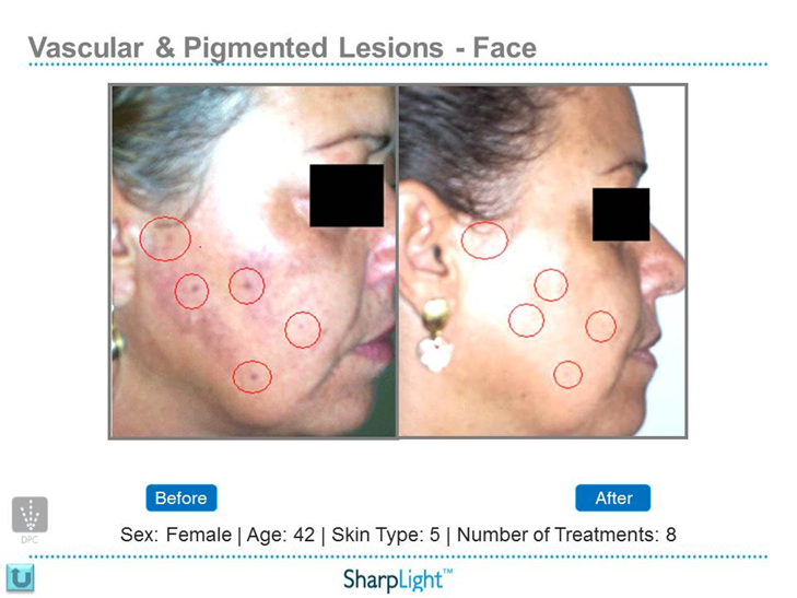 Refresh Laser & Skin Rejuvenation | 901 Heritage Dr SW, Calgary, AB T2V 2W8, Canada | Phone: (403) 464-9417