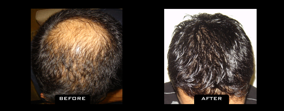 NuHair Medical Hair Transplant Centre | 4040 Veterans Pl NW Unit 200, Calgary, AB T3B 3R7, Canada | Phone: (403) 923-5954
