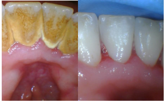 Hygiéniste dentaire mobile Nancy Robert | 7483 Rue Lautrec, Brossard, QC J4Y 3H7, Canada | Phone: (514) 625-8883