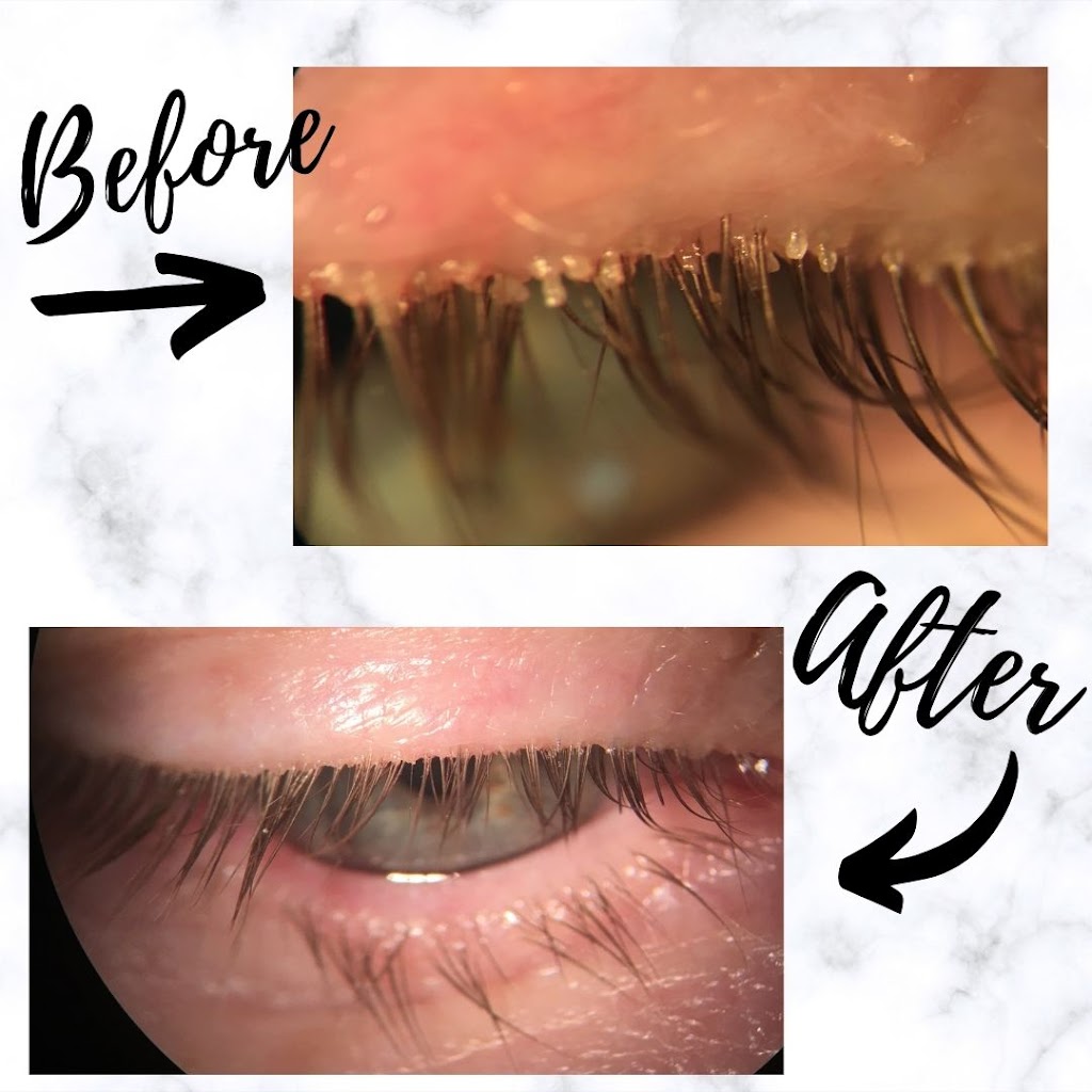 Calgary Dry Eye Treatment Center | 8720 Macleod Trail #3b, Calgary, AB T2H 0M4, Canada | Phone: (587) 317-9897