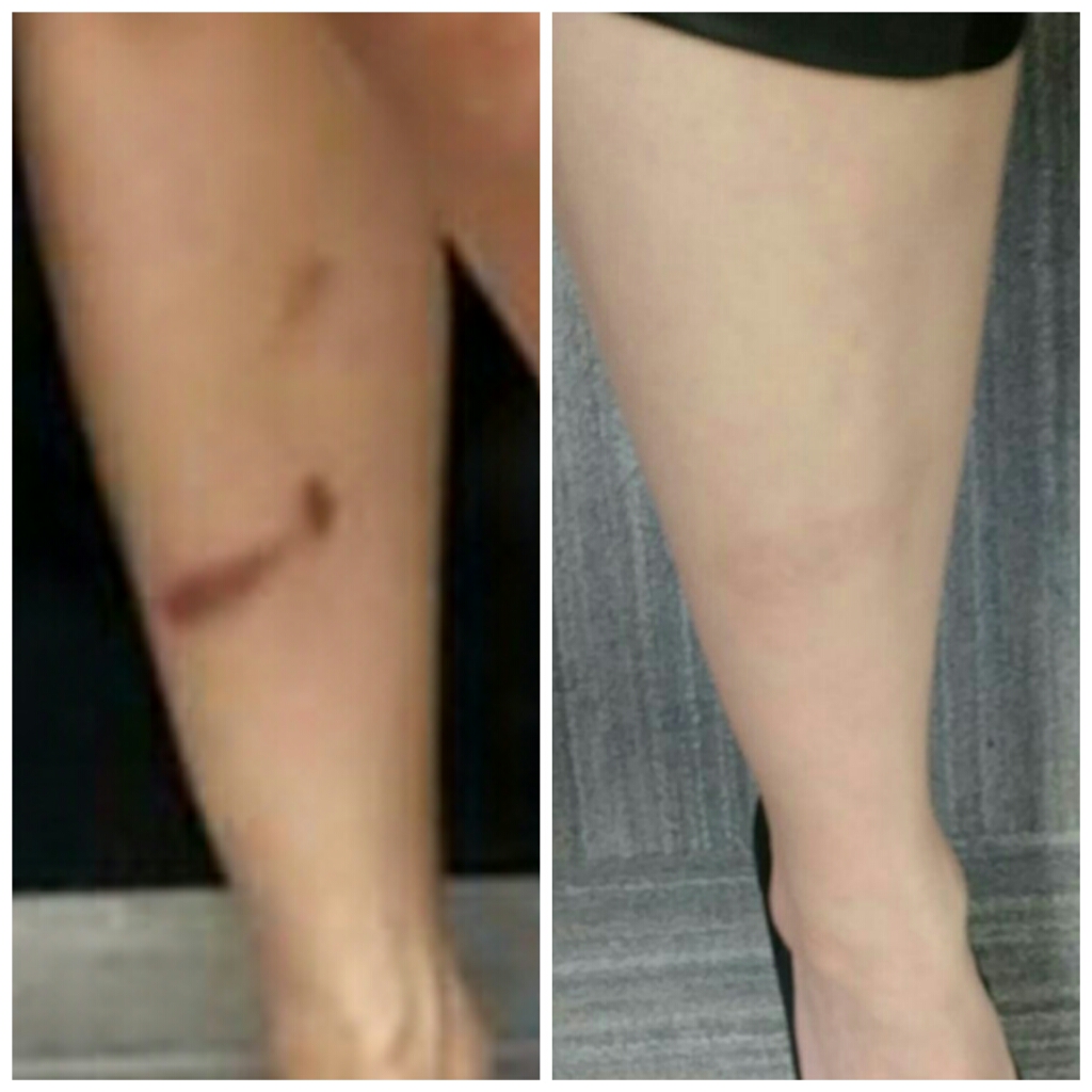 ProLaser | 1225 Stanley St, Windsor, ON N8X 4Z9, Canada | Phone: (519) 819-5296