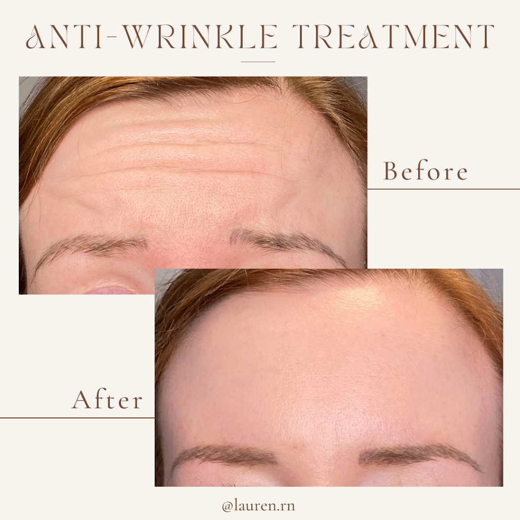 Lauren Landry RN - Halifax Injector: Botox and Dermal Fillers | 6461 Quinpool Rd, Halifax, NS B3L 1B1, Canada | Phone: (902) 789-1174