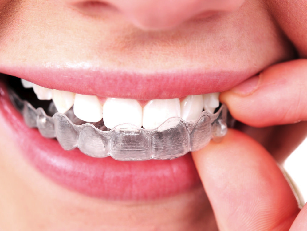Clinique Dentaire Dr Gilles Piquette | 14050 Boulevard Henri-Bourassa, Québec, QC G1G 5S9, Canada | Phone: (418) 628-6971