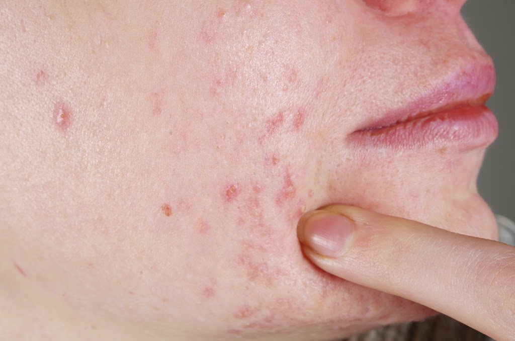 Acne Treatment Ottawa | 3320 McCarthy Rd #2006, Ottawa, ON K1V 0X3, Canada | Phone: (613) 714-0770