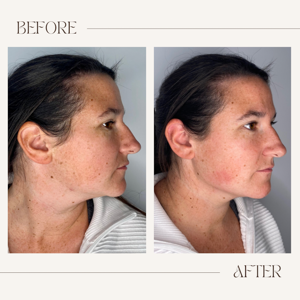 Lauren Landry RN - Halifax Injector: Botox and Dermal Fillers | 6461 Quinpool Rd, Halifax, NS B3L 1B1, Canada | Phone: (902) 789-1174