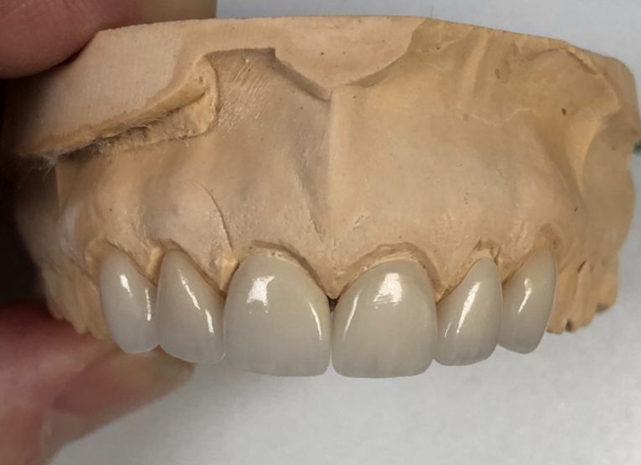 Innovative Dental Laboratories | 1706 Danforth Ave, Toronto, ON M4C 1H8, Canada | Phone: (416) 463-3138