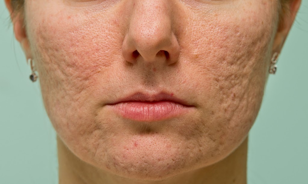 Acne Treatment Ottawa | 3320 McCarthy Rd #2006, Ottawa, ON K1V 0X3, Canada | Phone: (613) 714-0770