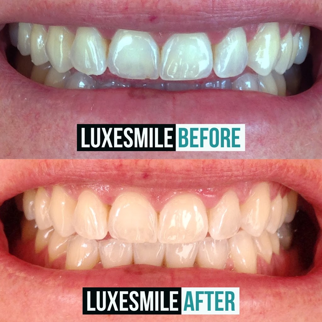LuxeSmile | Teeth Whitening is all we do! | 3455 Fairview St, Burlington, ON L7N 2R4, Canada | Phone: (905) 469-6093