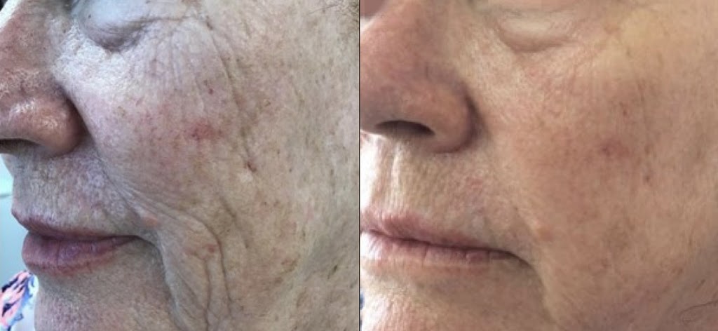 Carewell Laser Esthetics | 6490 Old Banff Coach Rd SW, Calgary, AB T3H 5R8, Canada | Phone: (604) 312-3034