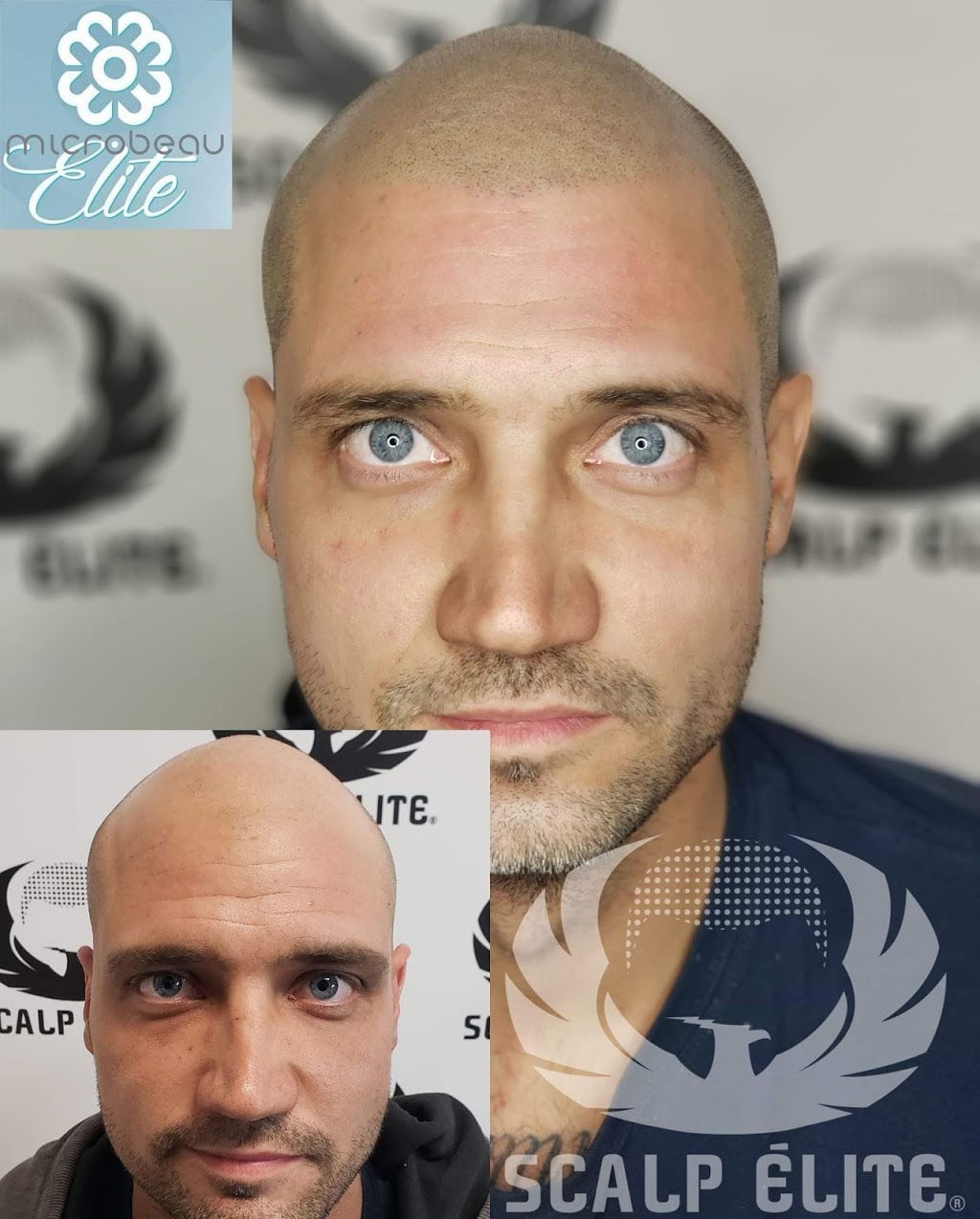 Micropigmentation Capillaire Scalp Élite Sherbrooke | 121 QC-216, Stoke, QC J0B 3G0, Canada | Phone: (819) 434-7477