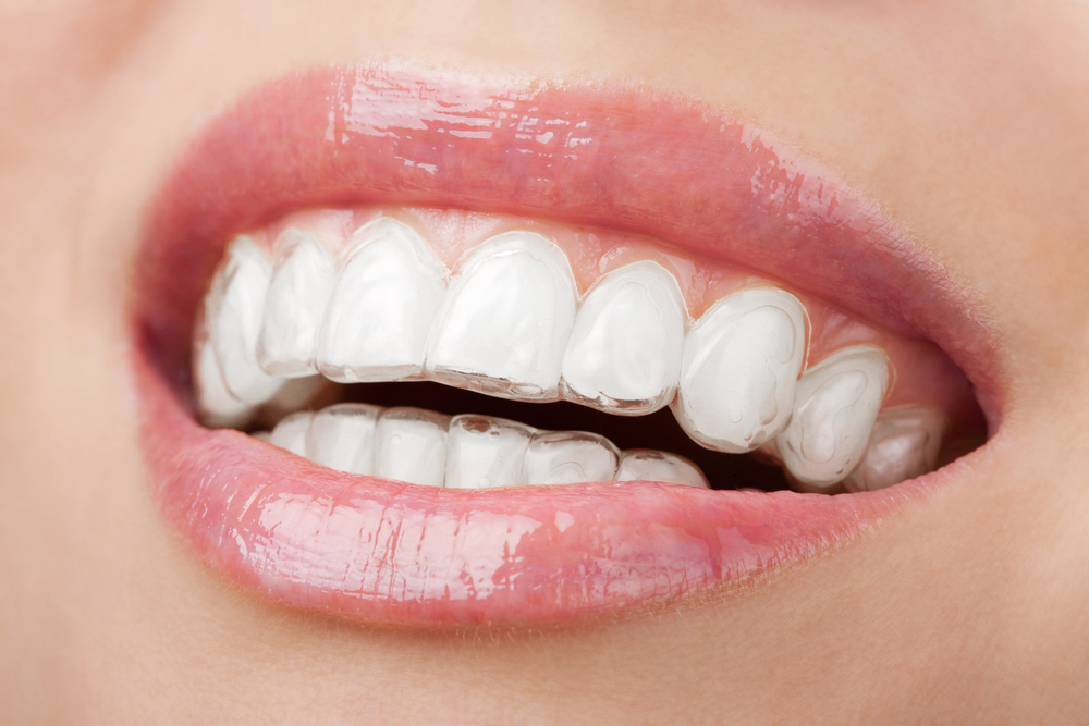 Nemes Ortho | 6900 Boulevard Décarie suite M250, Côte Saint-Luc, QC H3X 2T8, Canada | Phone: (514) 370-8887