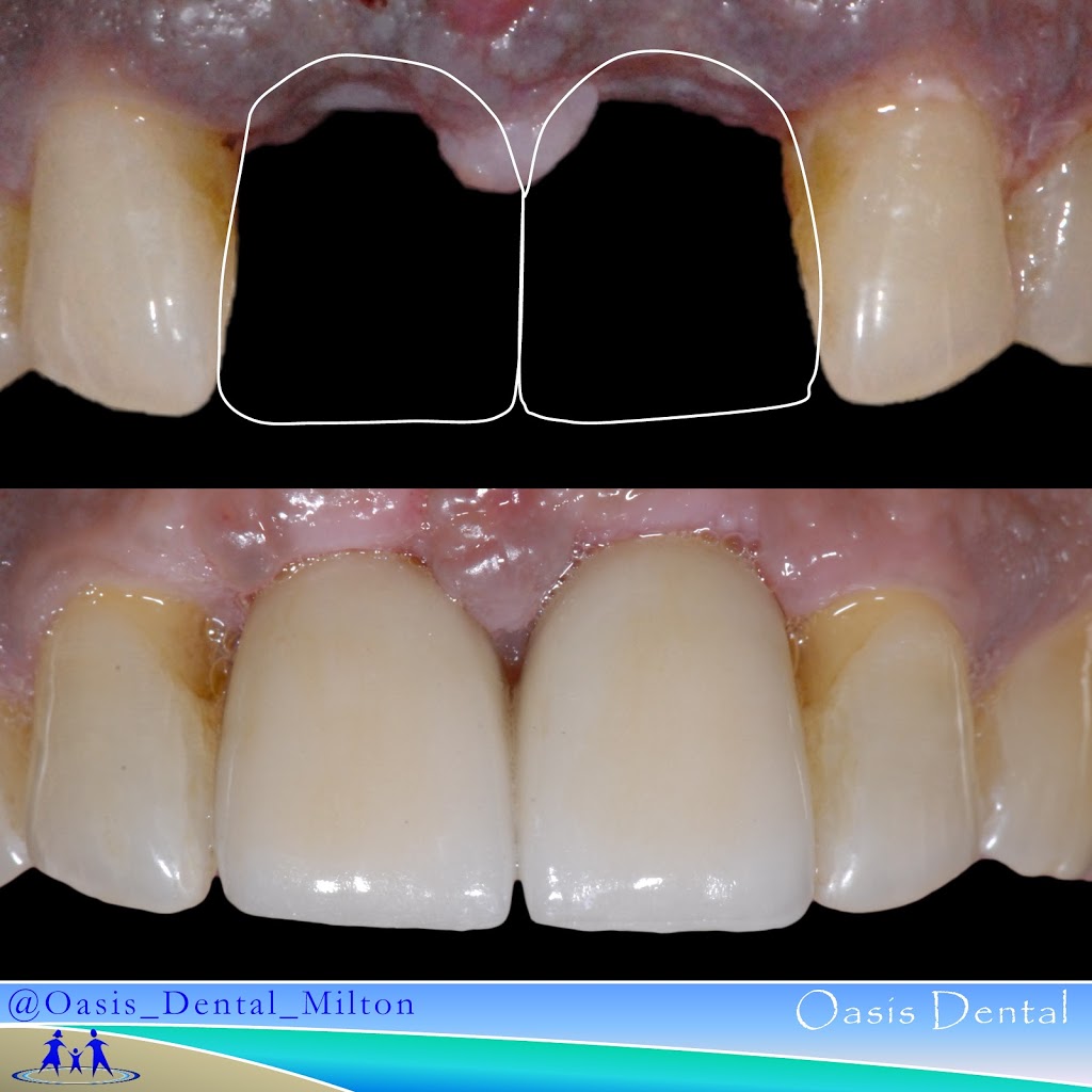 Oasis Dental Milton | 9030 Derry Rd W, Milton, ON L9T 7H9, Canada | Phone: (905) 876-2747
