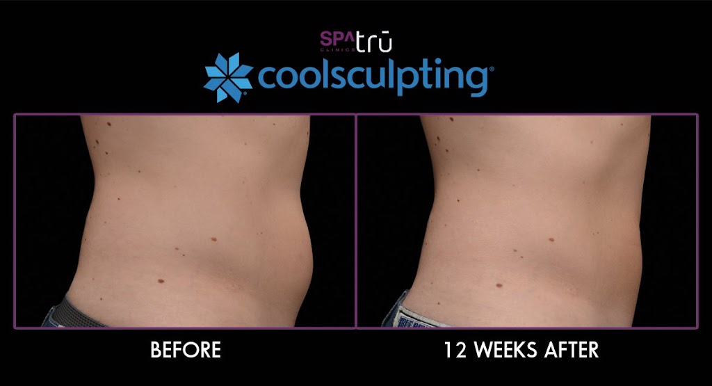 Spa Tru Clinics | Seven Oaks S/C 160, 32900 South Fraser Way, Abbotsford, BC V2S 5A1, Canada | Phone: (604) 744-5362