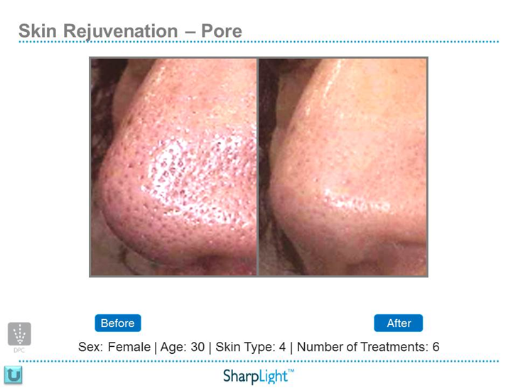 Refresh Laser & Skin Rejuvenation | 901 Heritage Dr SW, Calgary, AB T2V 2W8, Canada | Phone: (403) 464-9417
