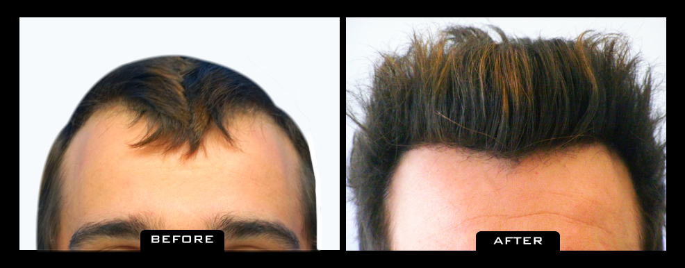 NuHair Medical Hair Transplant Centre | 4040 Veterans Pl NW Unit 200, Calgary, AB T3B 3R7, Canada | Phone: (403) 923-5954