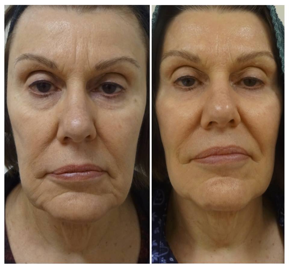 Odettes Skin Laser Wellness Clinic | 31 - 10042 Main Street, Lake Country, BC V4V 1P6, Canada | Phone: (250) 765-7892