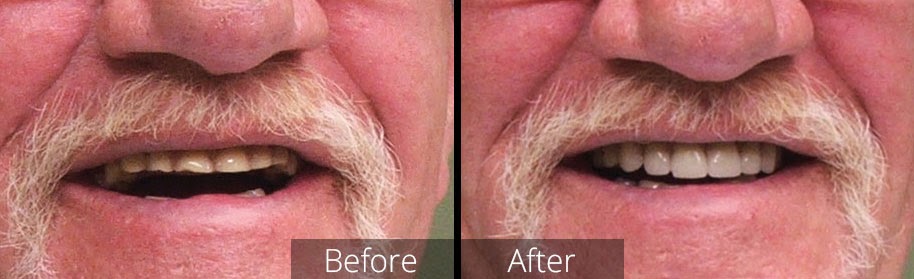 Saanich Walk-in Denture Clinic - Denturist in Victoria | 3581 Shelbourne St #101A, Victoria, BC V8P 4G8, Canada | Phone: (250) 595-1665