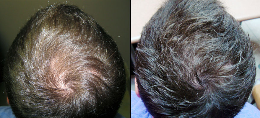 Sure Hair International | 43 Keefer Ct Unit #200, Hamilton, ON L8E 4V4, Canada | Phone: (905) 560-7500