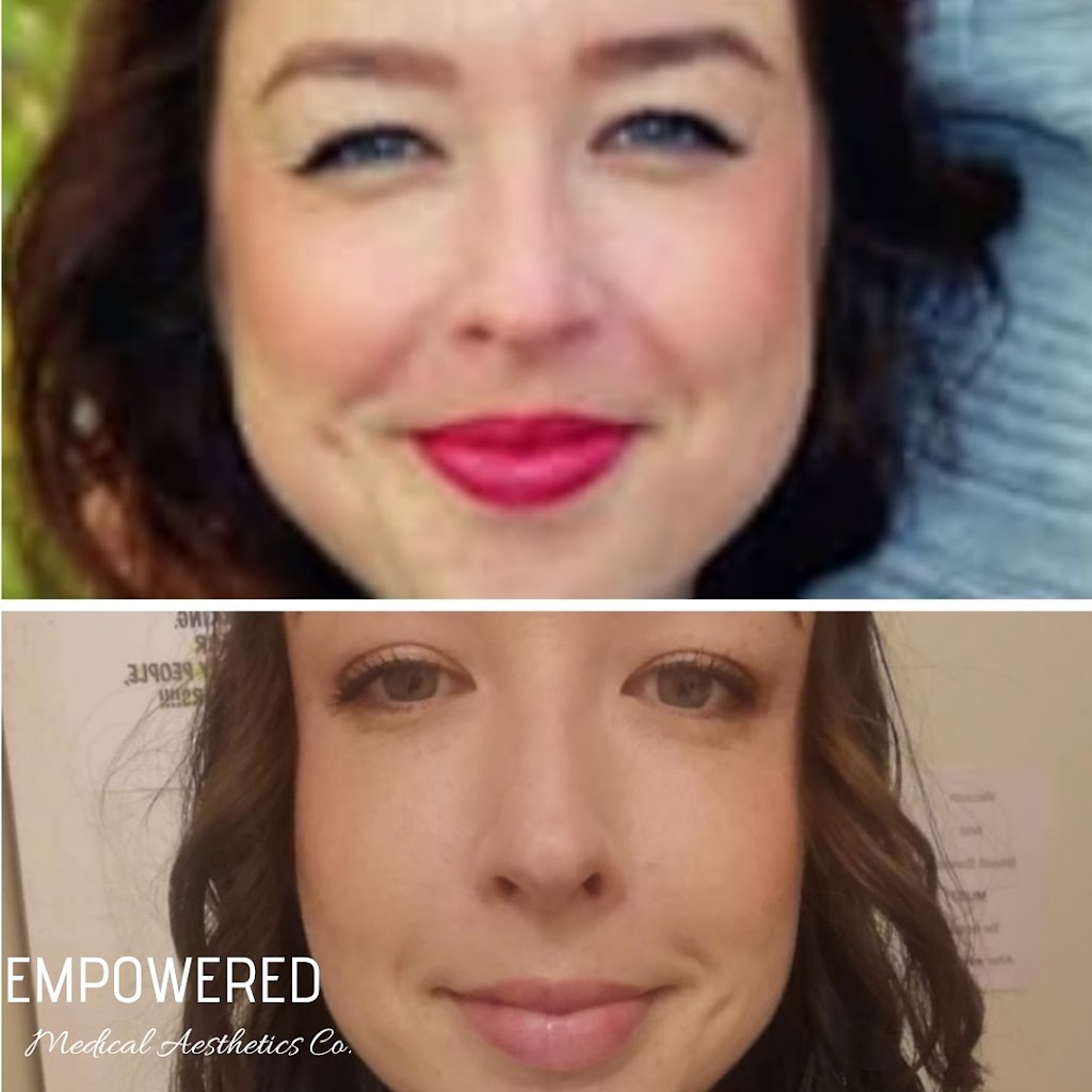 Empowered Medical Aesthetics Co. | 353 Manly St, Midland, ON L4R 3E1, Canada | Phone: (519) 216-8673