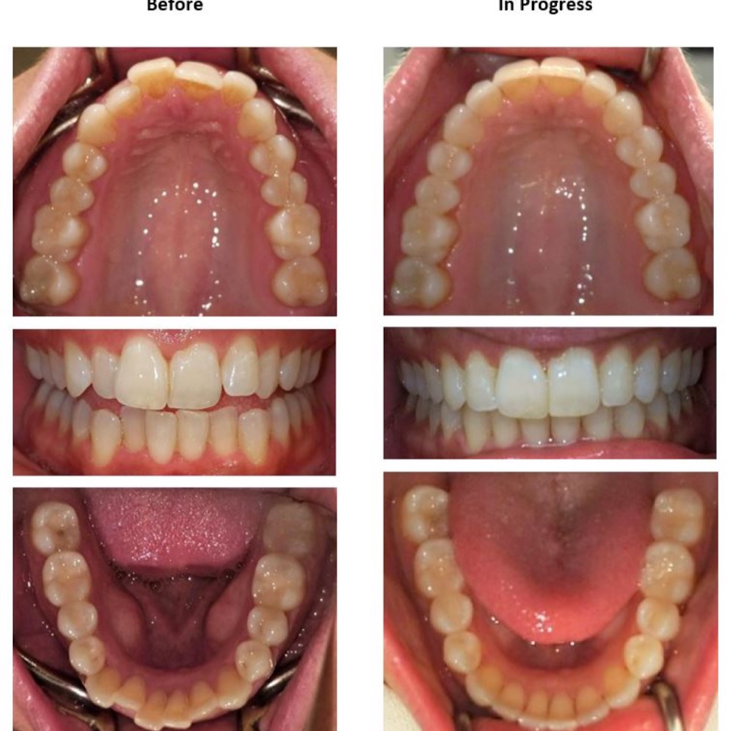 Oasis Dental Studio | 567 Clarke Rd Unit 106, Coquitlam, BC V3J 0L1, Canada | Phone: (604) 949-3030