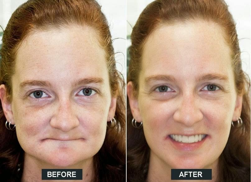 Bracebridge Denture Clinic | Archdekin Medical Building, 205 Hiram St, Bracebridge, ON P1L 2C1, Canada | Phone: (705) 646-0504